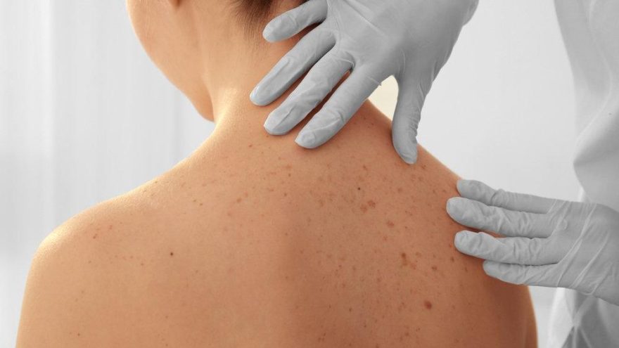 Cilt kanseri ve biorezonans 1 cilt kanseri