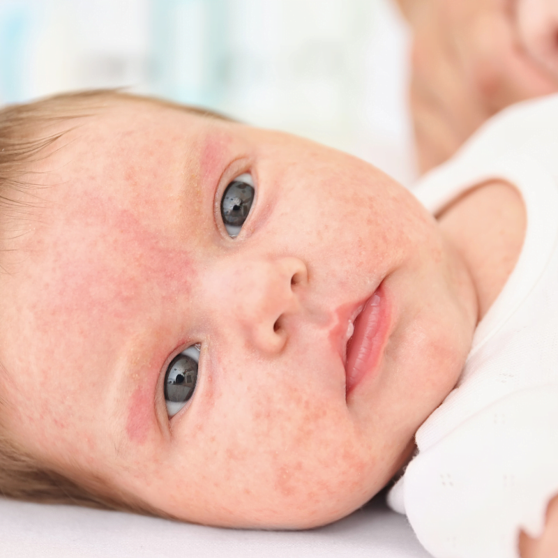 Bebeklerde Alerji Testi Ne Zaman Yapılır