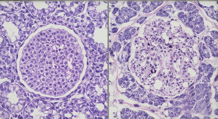 insulin direnci 2 İnsülin direnci nasıl kırılır?