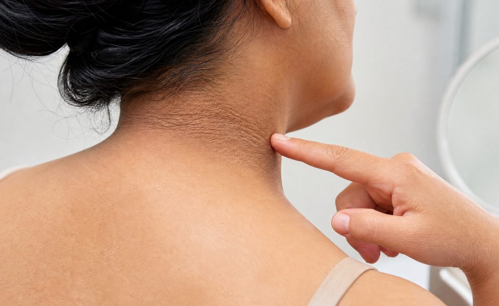 insulin direnci belirtileri İnsülin Direnci Belirtileri Nelerdir?